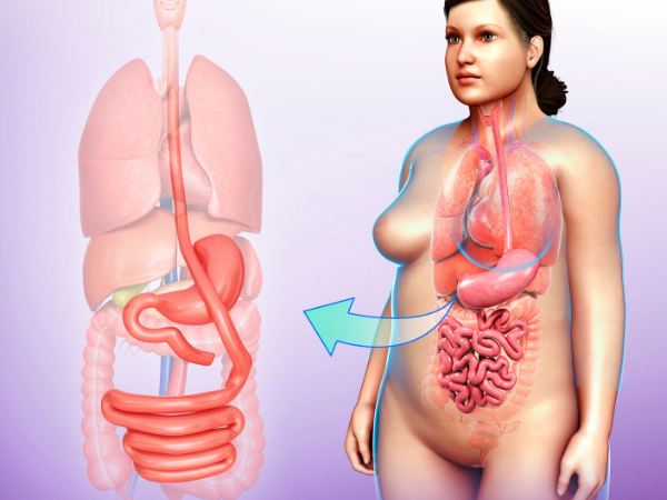 Mini Gastric Bypass